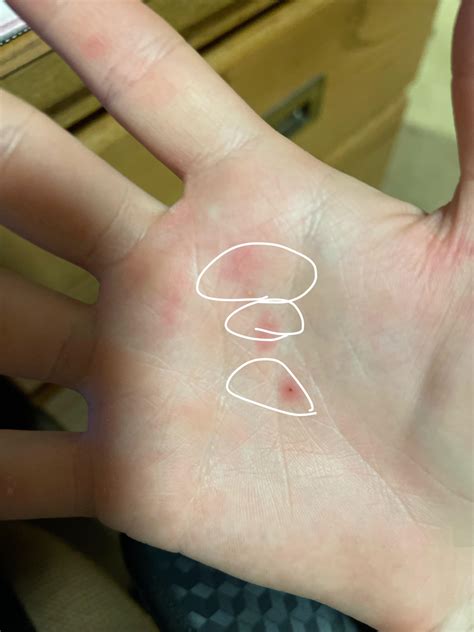 Why Do I Have Small Bumps On My Hands That Hurt at Kristy Breeden blog