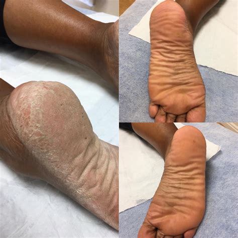 Callus Peel Feet Treatment - Ultra Smooth Feet - The Beauty Refinery