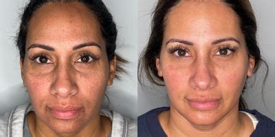 DiamondGlow Before & After Pictures - RealSelf