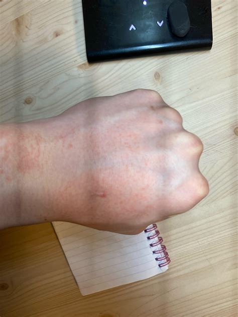 eczema in armpit? started a few weeks ago and is only in one, super