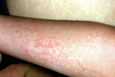 Common Skin Rashes in Children: 16 Types and Causes
