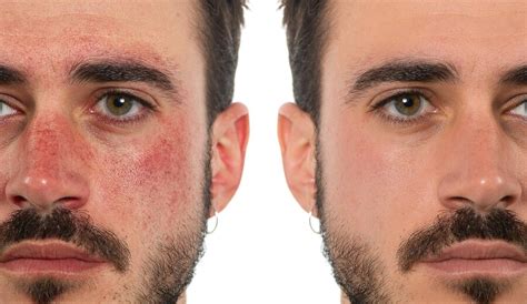 Premium Photo | Before and after a treatment for rosacea in a man's face