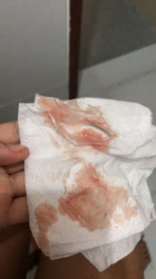 Sangramento Rosado O Que Pode Ser - 13s com sangramento rosado | BabyCenter