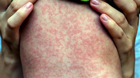 common skin rashes pictures   treatment