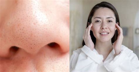 8 Unbelievable Blackhead Removal Tips You've Probably Never Heard Of (2024) - 9gu3a8w
