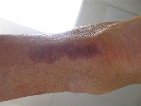 pressure injuries accessmedicine network