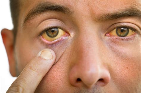 Doenca Que Deixa A Pessoa Amarela - Ictericia De Pele Amarela Uma Pele Amarela Colorida Icterícia