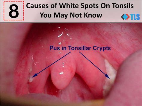 You Should Consult A Doctor If Your Swollen White Uvula Is Accompanied By A Fever Or Pain 3