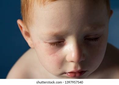 Allergy Pollen Child Has Red Eyes Stock Photo 1397957540 | Shutterstock