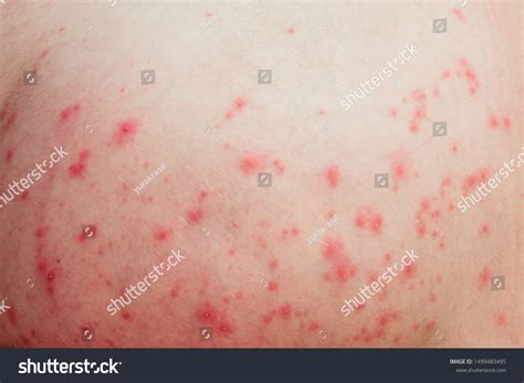red spots  skin close stock photo  shutterstock