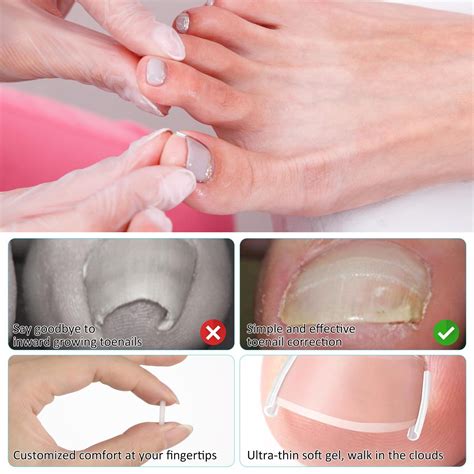 (50+1) Pcs Ingrown Toenail Corrector Treatment Set Aster