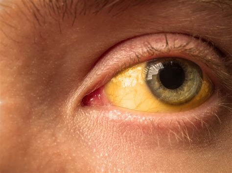 What Causes Yellow Eyes? - Access Eye