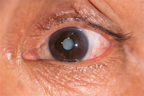 What is a Cataract? | Queens NY | Progressive Ophthalmology