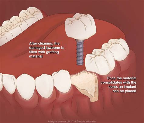 Bone Grafting Los Algodones, Mexico - Mexicali - Cosmetic & Implant ...