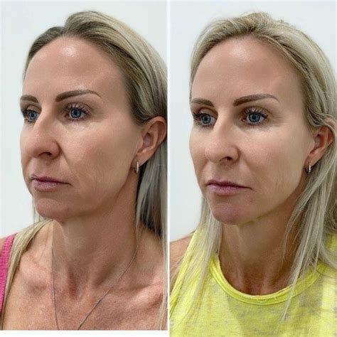 Stomach Threading Before And After at Crystal Yazzie blog