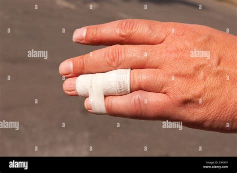 Dislocated Finger Stock Photos & Dislocated Finger Stock Images - Alamy