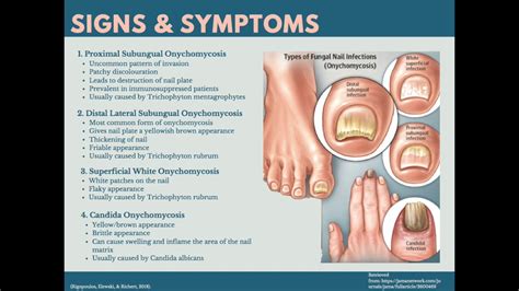 ONYCHOMYCOSIS - YouTube