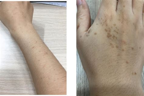 nam da tay  tu het khong nguyen nhan va cach tri nam tay