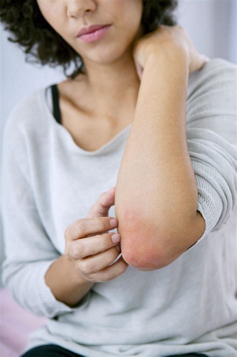 psoriatic arthritis medlineplus
