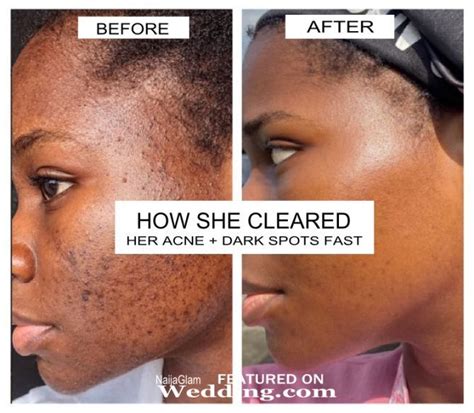 How She Cleared Her Stubborn Pimples and Dark Spots Fast (Skincare ...