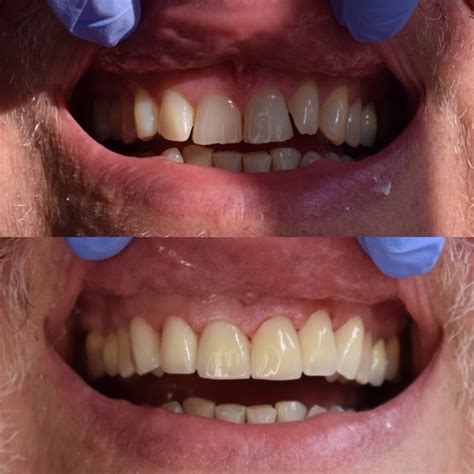 Before and After Veneers Procedure | Dr. Christian Chung, D.D.S.