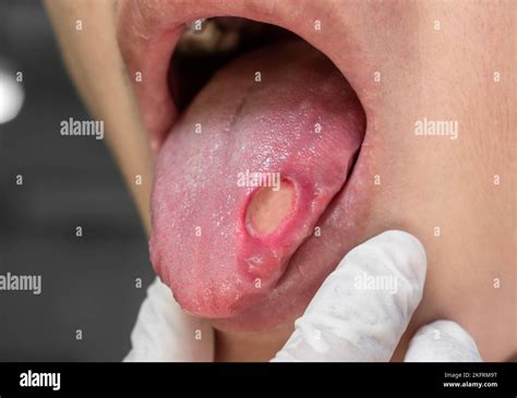 Ulcer at the tongue of Asian male patient. Diagnosis may be aphthous ulcer, canker sore, stress ...