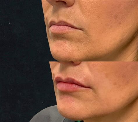 lip lines treatments  lip wrinkles filler  surgical