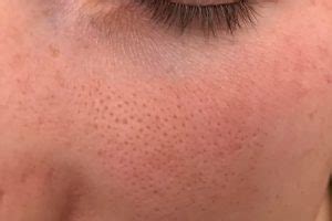 Holes in Face (Pores or Pockmarks) - How to Minimize - Skin Care Geeks