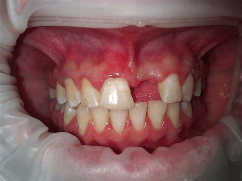 Missed/detached composite tooth pontic | Download Scientific Diagram