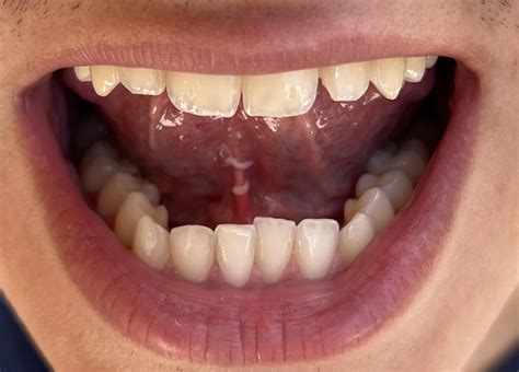 What is that white stuff under my tongue? Should I be concerned? I woke