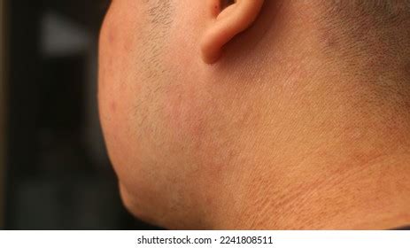 atopic dermatitis eczema eksim bahasa condition stock photo