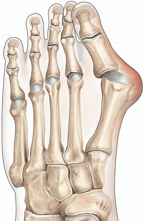 Bunion surgery | healthdirect