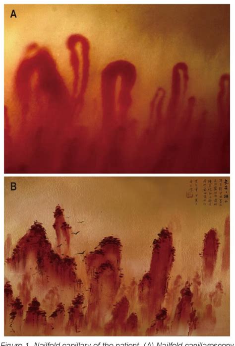 active pattern  nailfold capillaroscopy   patient  systemic