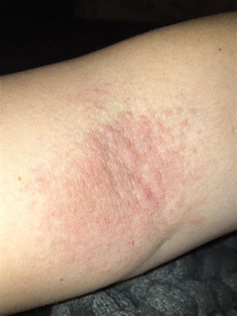 Itchy Rash On Arm What Cancer Can Cause Itchy Skin? Denvax