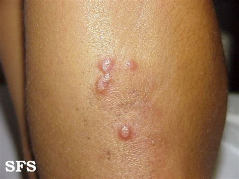Erythema Elevatum Diutinum - NC Commons