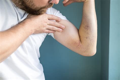 older skin bruising   prevention site