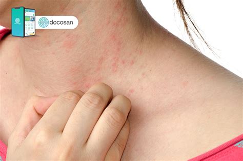 li  gay ngua toan  va cach lam diu  ngua