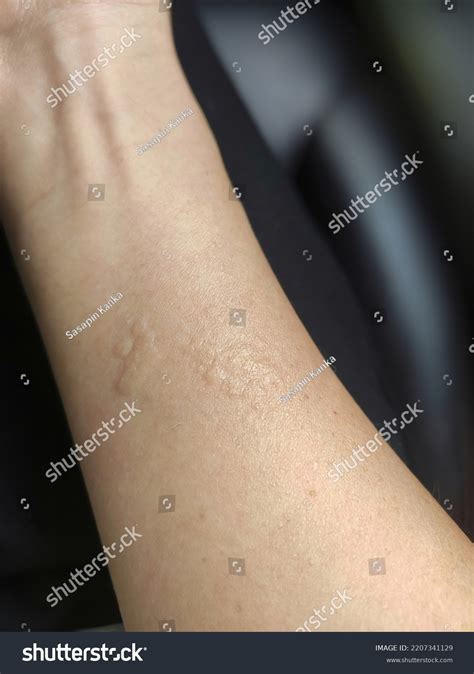 urticaria hives weals welts nettle rash stock photo