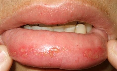 clear bubble   lip bump  lip mucous cyst hxdz