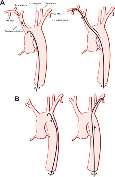 Angiography of Coronary Bypass Grafts | Thoracic Key