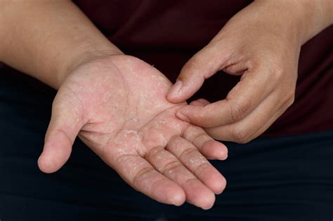 Mãos Descascando O Que Pode Ser - Foto de Mãos Secas Descascando A Pele Na Mão E Nos Dedos Alergia Ao Ar ...