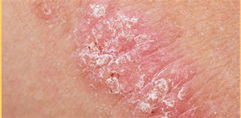 Psoriasis or Eczema | psoriasisSPEAKS