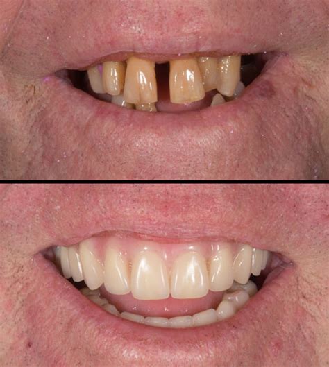 Clinic – NovaDenture – Implant Retained Dentures