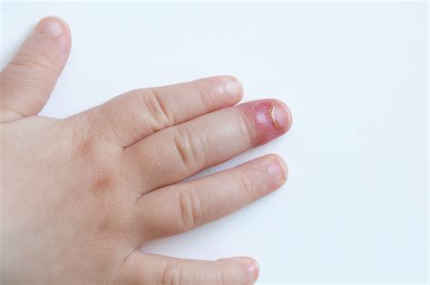 chronic paronychia toe