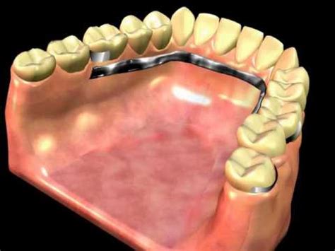 Partial Denture Clasp Types