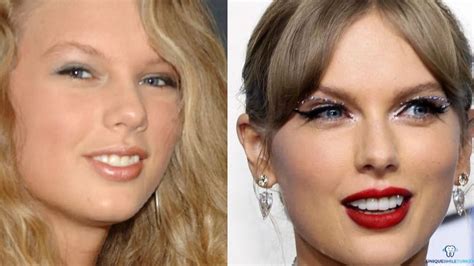 Taylor Swift Veneers: Transformation of Teeth