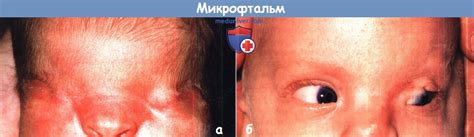 Причины и варианты микрофтальма у ребенка