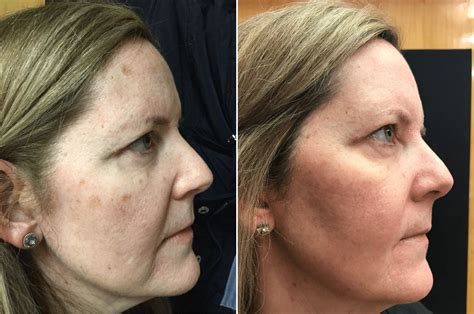 laser dark spot removal recovery  george redden blog