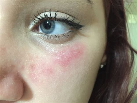 What Does An Allergic Reaction To Antibiotics Look Like