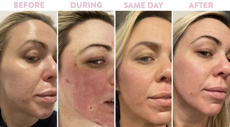 PRP - Skinspire Laser&Skin Clinic